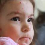 Fetita bolnava de rujeola cu eruptii pe fata